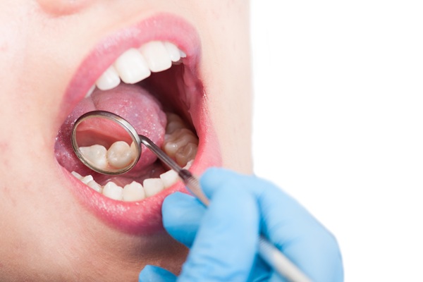 How Long Does A Dental Filling Last?