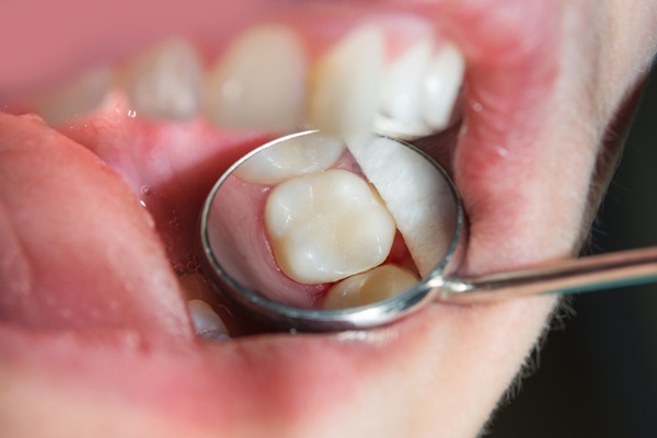 What Is A Tooth Filling Made From?